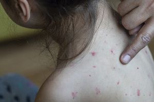 El sarampión nos obliga a estar alertas