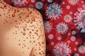 Viruela del mono: qué es, cómo se contagia y cuáles son los síntomas