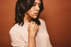 Vitiligo: una despigmentación progresiva en la piel