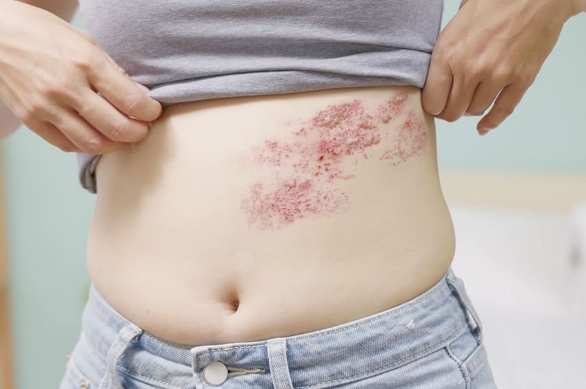 Herpes zóster: una erupción dolorosa